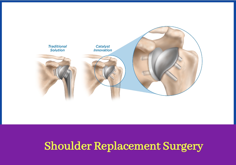 Shoulder Replacement Surgery Doctor In Purnea